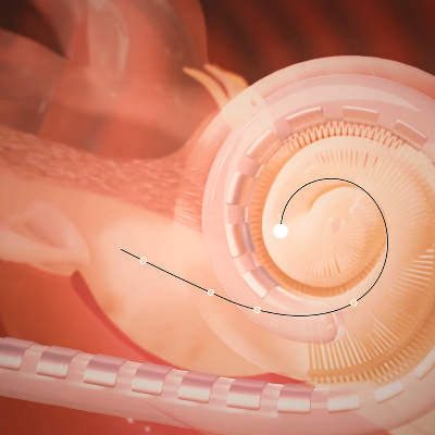 Cochlear Electrodes